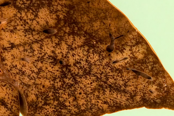'Nutmeg' liver