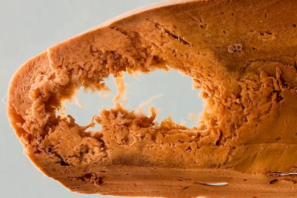 Amoebic abscess in the liver