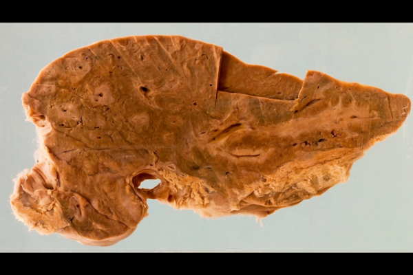 Liver with 'pipe stem fibrosis' due to schistosomiasis