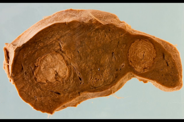 Syphilitic gummas in the liver