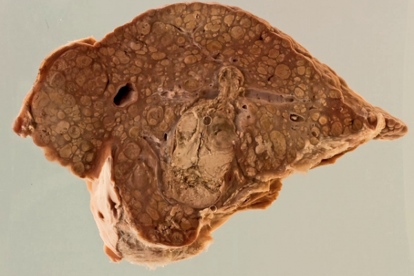 Hepatocellular carcinoma developing in a cirrhotic liver