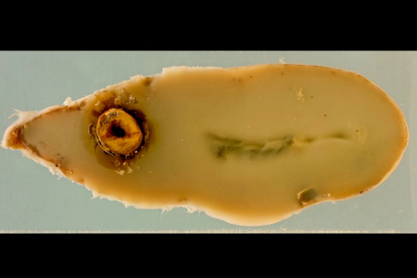 Mucocoele of the gallbladder