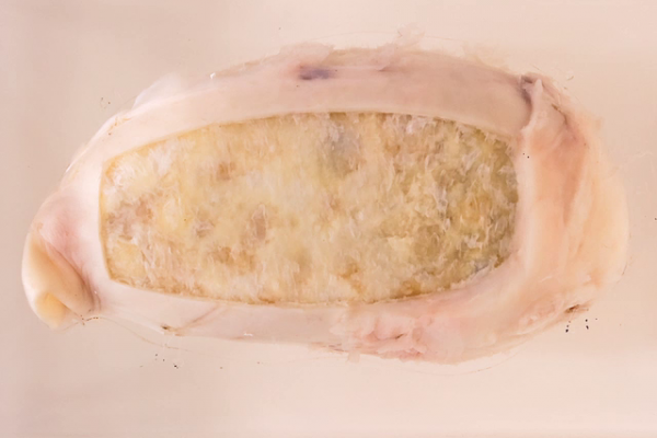 Calcium carbonate gallstone