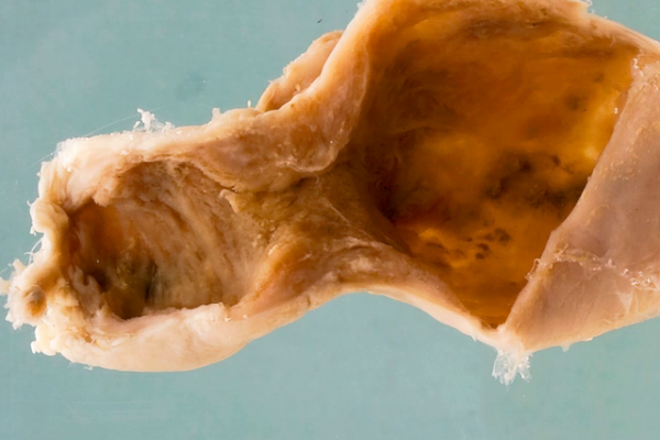 Adenocarcinoma of the gallbladder (early)