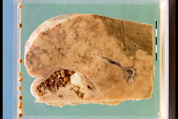 Adenocarcinoma of the gallbladder