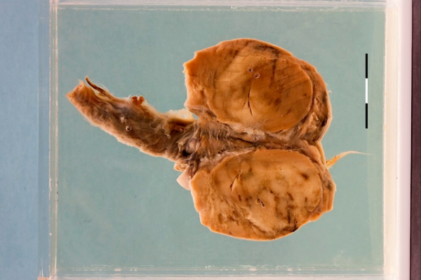 High grade lymphoma in HIV/Aids