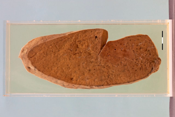 Pneumocystsis jirovecii pneumonia