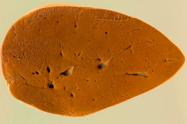 Fatty liver (IP)