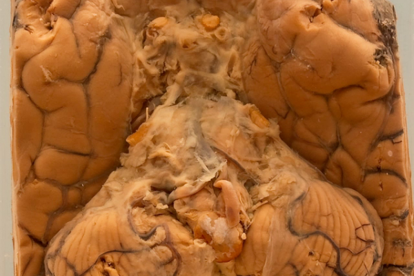 Pneumococcal meningitis