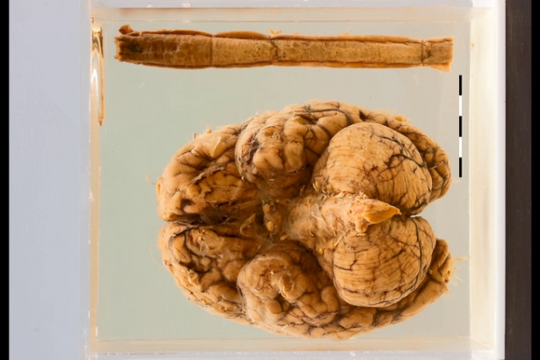 Tuberculous meningitis