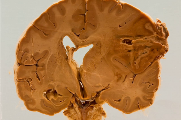 Actinomycotic cerebral abscess