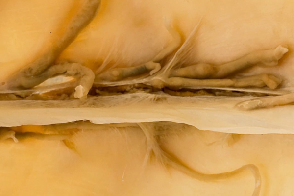 Sagittal sinus thrombosis