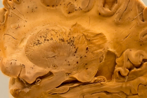 The brain in falciparum malaria