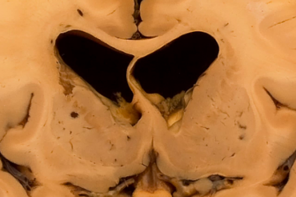 Cerebral atherosclerosis