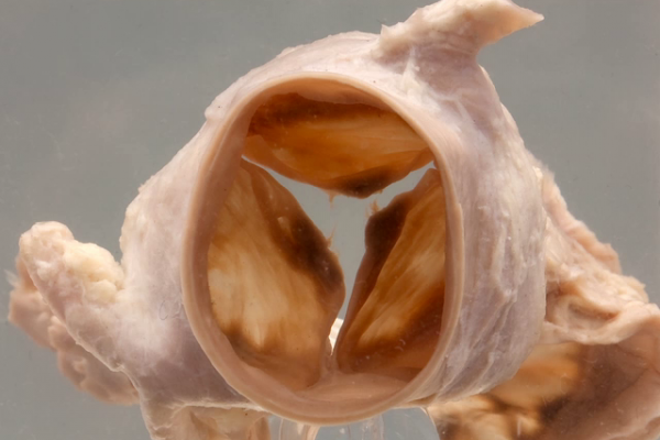 Normal heart aortic root