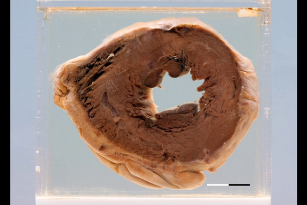 Normal heart midventricular transverse section