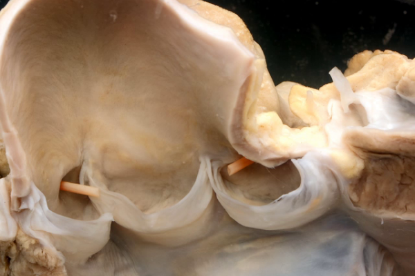Normal heart left ventricular outflow tract
