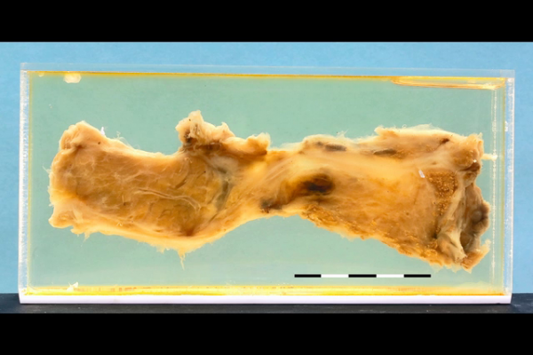 Traumatic rupture of the pancreas