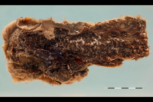 Acute haemorrhagic pancreatitis