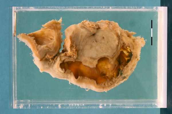 Chronic pancreatitis