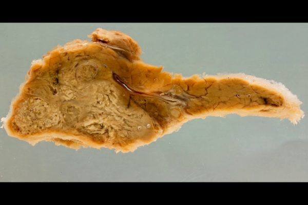 Carcinoma of the head of the pancreas