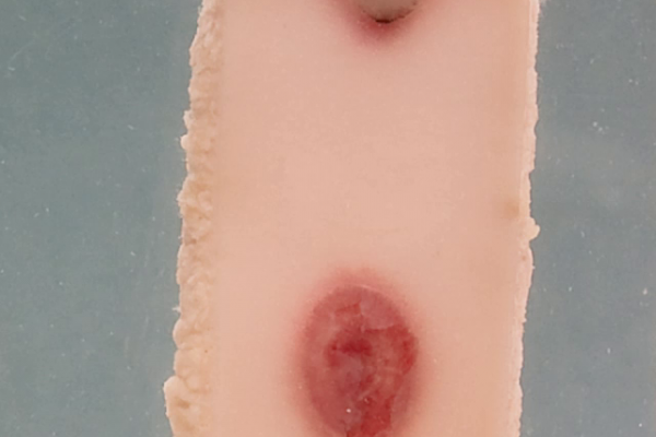 Lung and skin manifestations of pseudomonas septicaemia