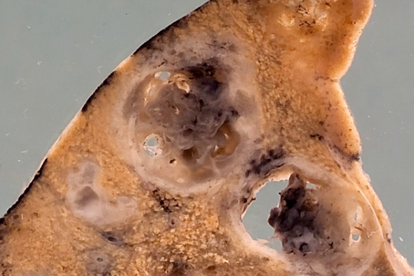 Lung with abscesses due to acute aspergillus infection