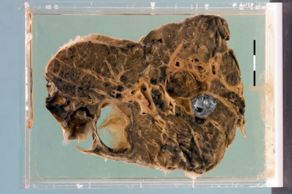 Hydatid cysts