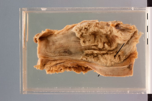 Oesophageal carcinoma with fistula formation