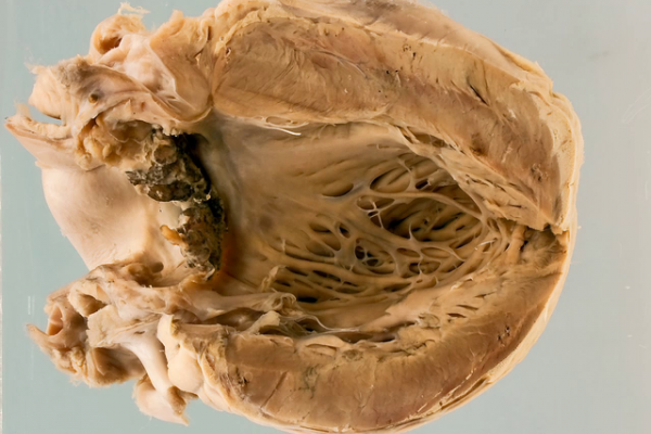 Acute bacterial endocarditis