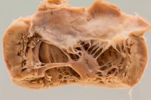 Acute rheumatic fever