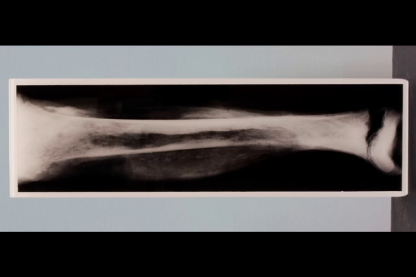 Acute staphylococcal osteomyelitis