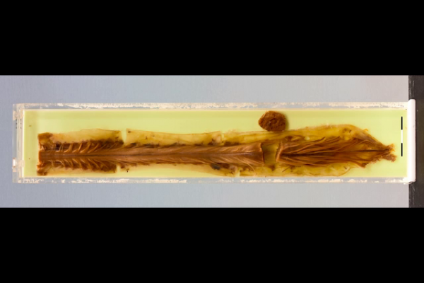 Ependymoma of the spinal cord