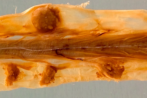 Spinal meningioma