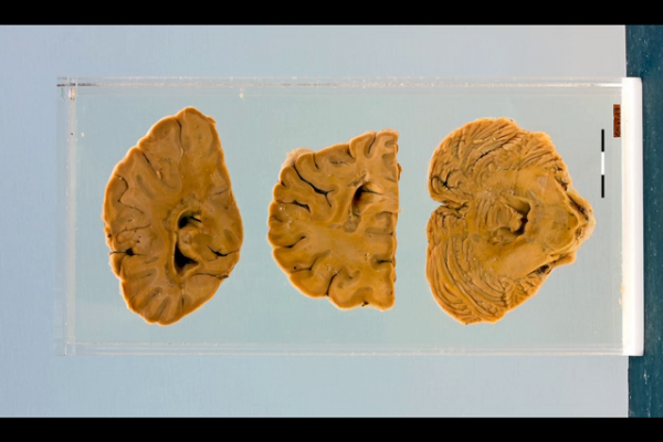 Multiple sclerosis