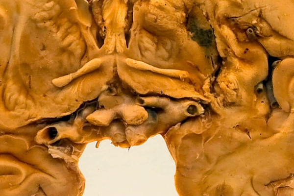 Haemorrhagic infarct of the basal ganglia