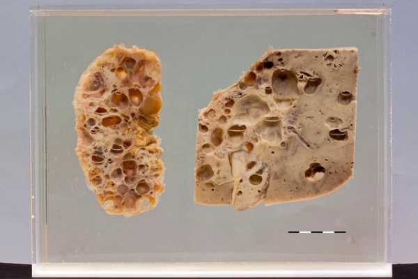 Autosomal dominant polycystic kidney disease (AD-PKD)