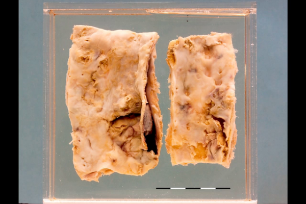 Severe atheroma