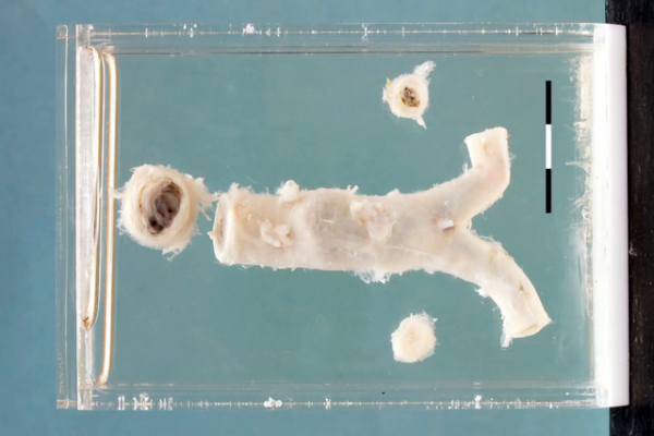 Thrombotic occlusion of the aorta