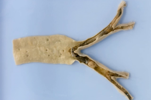 Saddle embolus at the aortic bifurcation