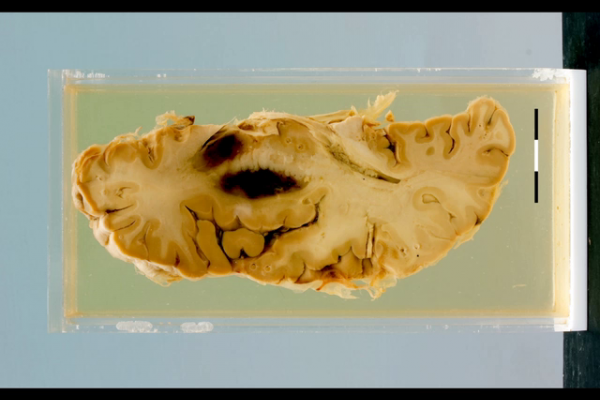 Cerebral infarct with haemorrhagic necrosis