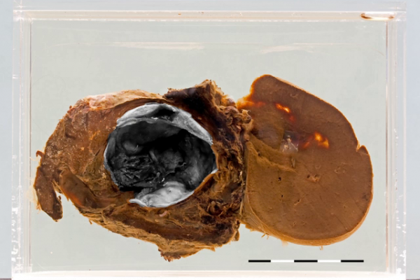 Ruptured splenic artery aneurysm