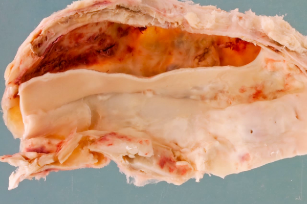 Aortic dissection