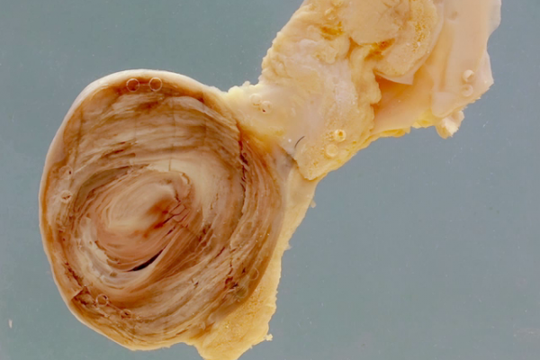 False aneurysm of the external iliac artery