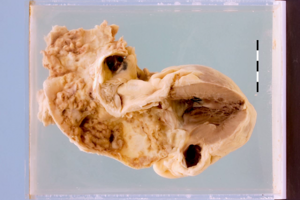 Syphilitic aortitis with atheroma