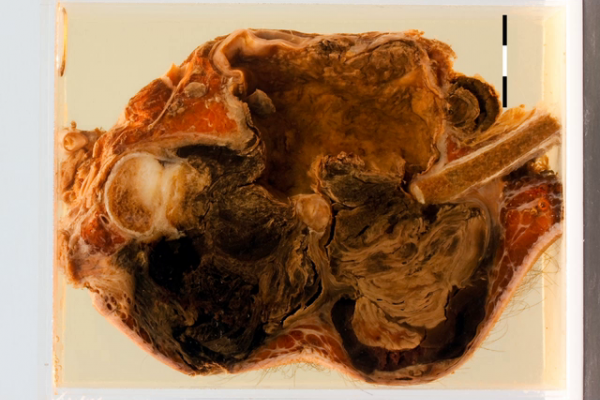 Ruptured syphilitic aneurysm