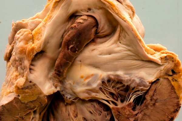 Paradoxical embolism