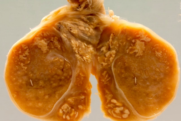 Tuberculosis of the testis-epididymis