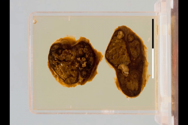 Tuberculous lymphadenitis