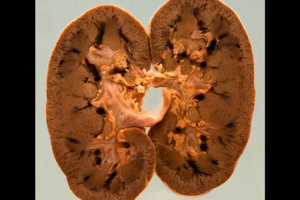 Kidney showing vascular congestion